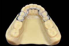 Lingual-Retainer-1