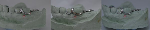 Bertram Dental Lab Repair Services Example 1