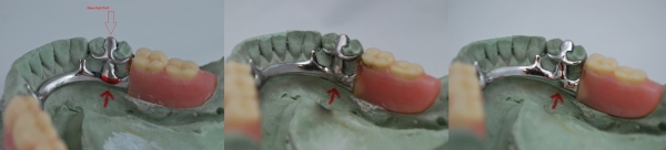 Bertram Dental Lab Repair Services Example 2