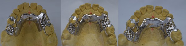 Bertram Dental Lab Repair Services Example 3